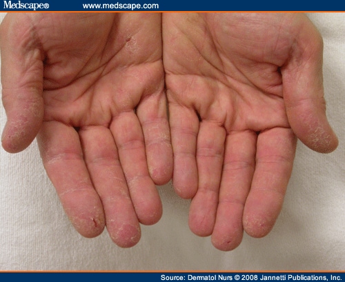 6 Ways to Treat Dermatitis – wikiHow