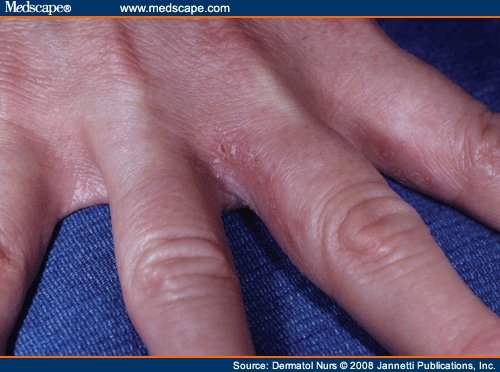 Contact dermatitis - NHS Choices