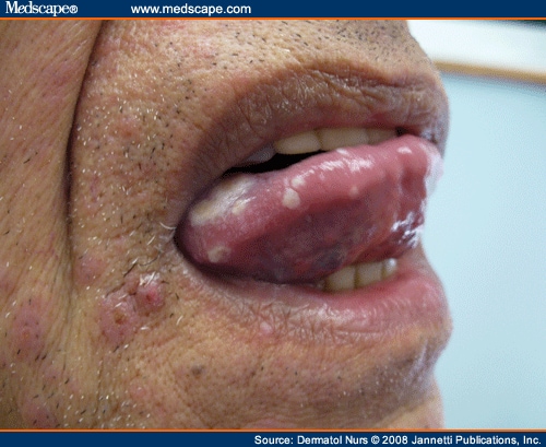 ulcers on tongue. ulcers on the tongue,