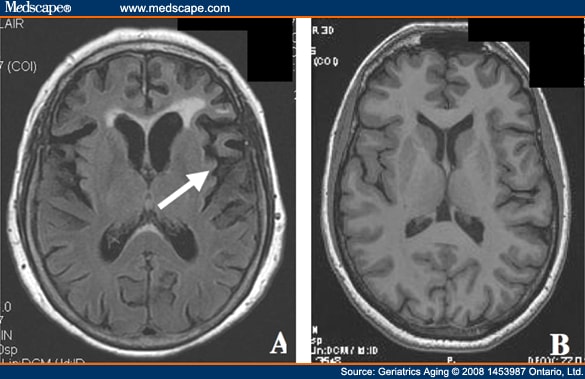 mri brain scan. MRI scan of the rain of a