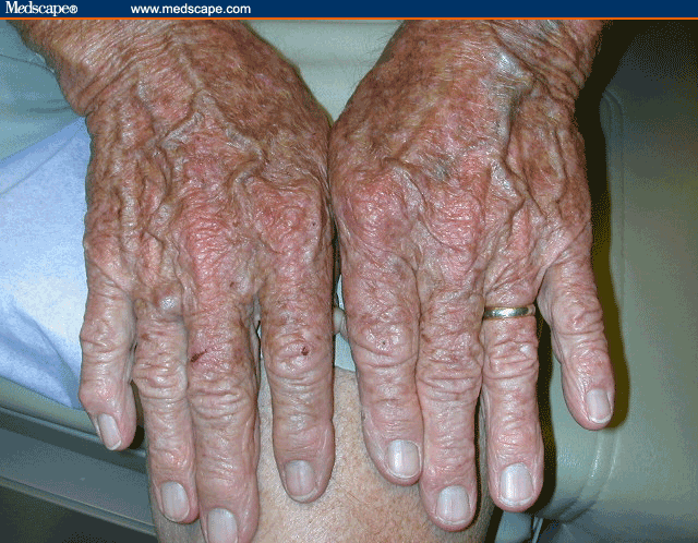 normal-aging-of-the-skin