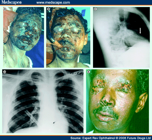 Bomb Blast Injuries