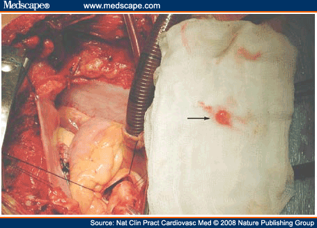 cardiac fibroelastoma