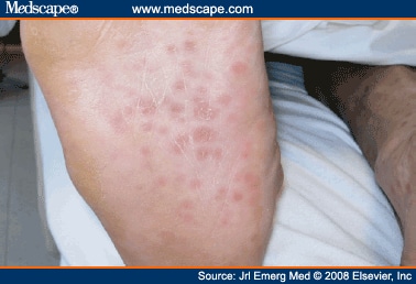 Itchy rash on arch of foot - Doctor answers on HealthcareMagic