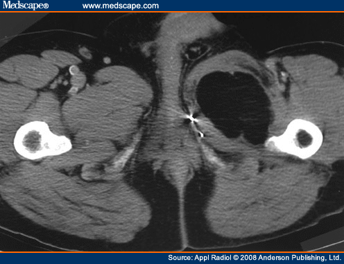 Liposarcoma Ct