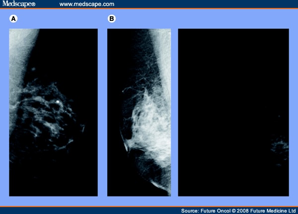 Mammography For Breast Cancer. Full-field digital mammograms.