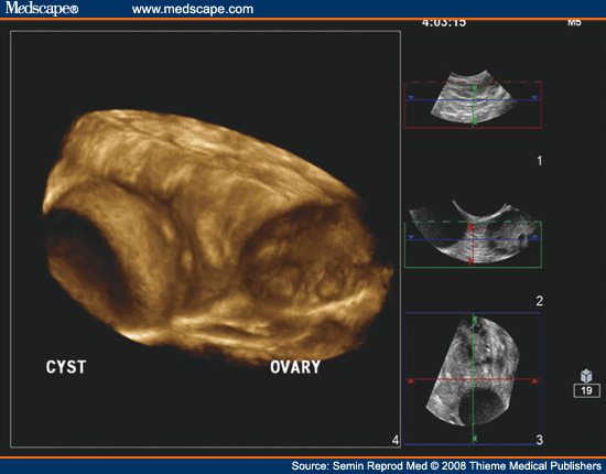Pelvic Pain, Adnexal Masses, and Ultrasound