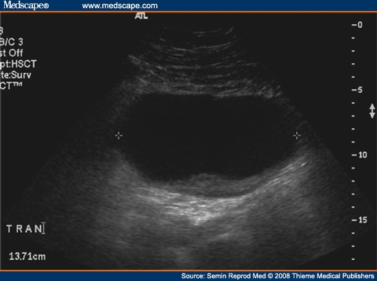 Pelvic Pain, Adnexal Masses, and Ultrasound