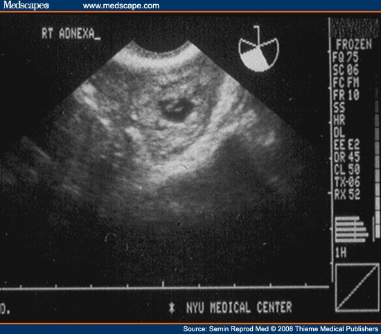 sonography test for pregnancy. This pregnancy is quot;normalquot; in