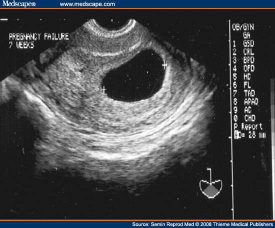 The gestational sac diameter measures 2.8 cm, or 28 mm (calipers).