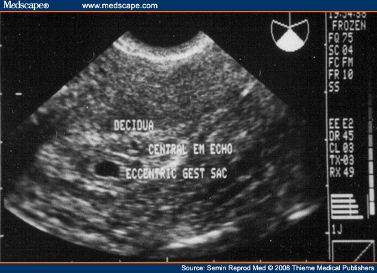 Gestational sac is seen here to be burrowing into the posterior endometrium 