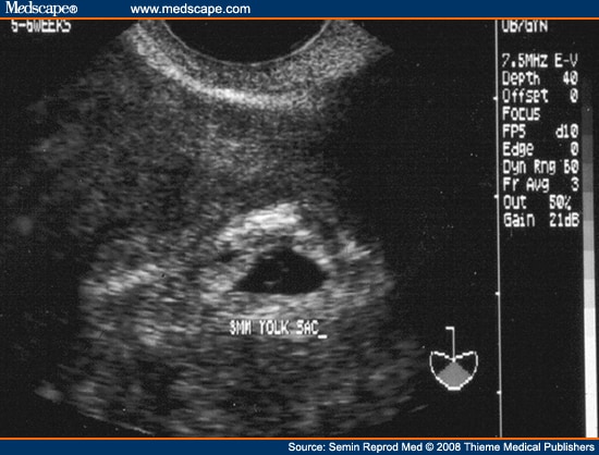 fetus at 6 weeks. at 5 to 6 weeks LMP.
