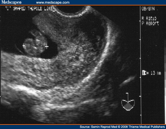 abnormal gallbladder ultrasound images. A short history of the development of ultrasound in pregnancy