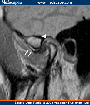 Tmj Mri