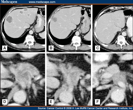 Pancreatic Cancer Prognosis For Stage 4 Pancreatic Cancer 3262