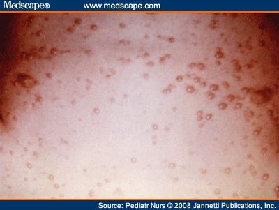herpes pictures. Herpes Simplex Rash over Trunk