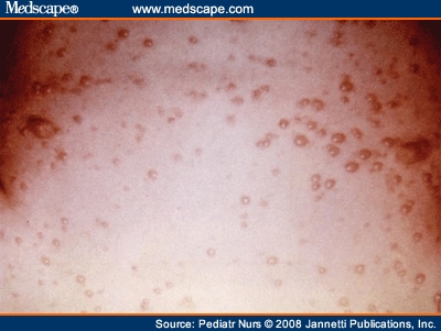 herpes symptoms lips. Herpes Simplex Rash over Trunk