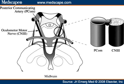 aneurysm artery posterior communicating nerve palsy third cn willis circle compressing iii arising superior shown