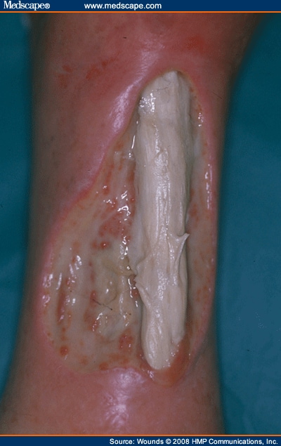 What causes a varicose ulcer? - Memorial Vein Center