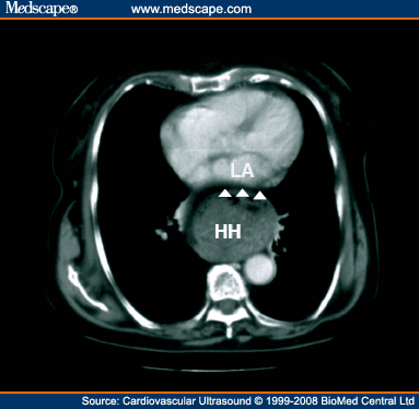 Hiatal hernia on ct scan