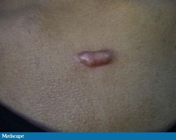 Close-up of keloid with typical raised area with flat surface.