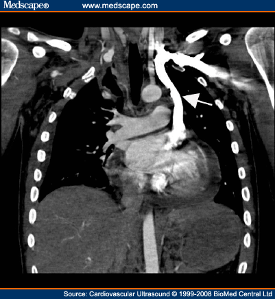 Persistent Left Superior Vena Cava: A Case Report And Review Of Literature