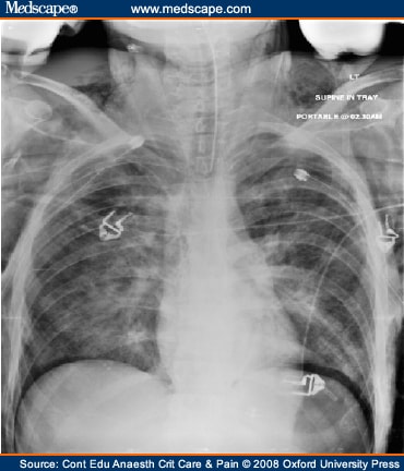 Cxr Ards