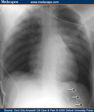 thymic shadow cxr