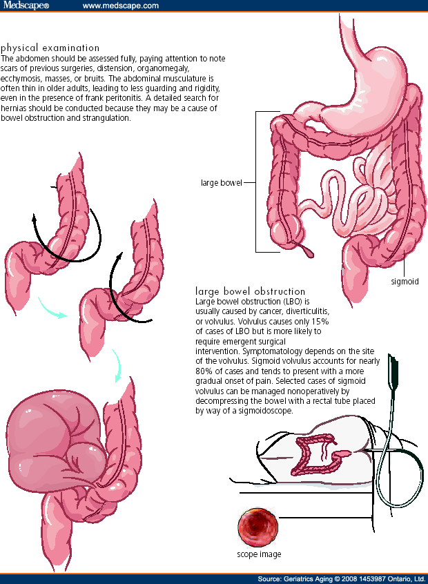 Sigmoid Volvulus Causes Mikihisaab