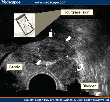 Curved Cervix