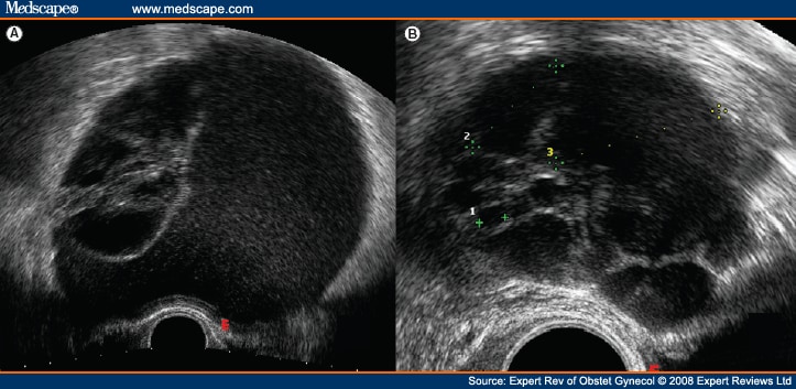 Ruptured Ovarian Cyst. Ovarian Cyst Pregnancy Test