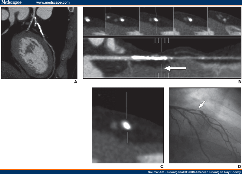 Coronary Artery Calcification