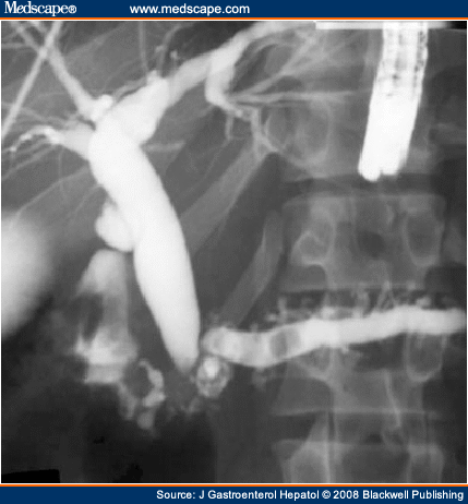 common bile duct and pancreatic duct. The Common Bile Duct (CBD) is