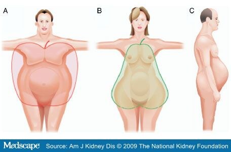 Truncal Obesity