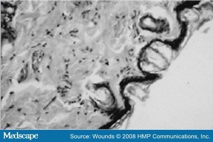 Corticosteroids effects on wound healing