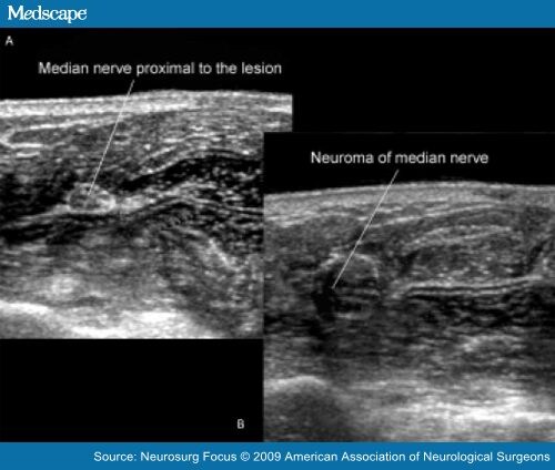 Ultrasonography In Evaluating Peripheral Nerve Entrapment