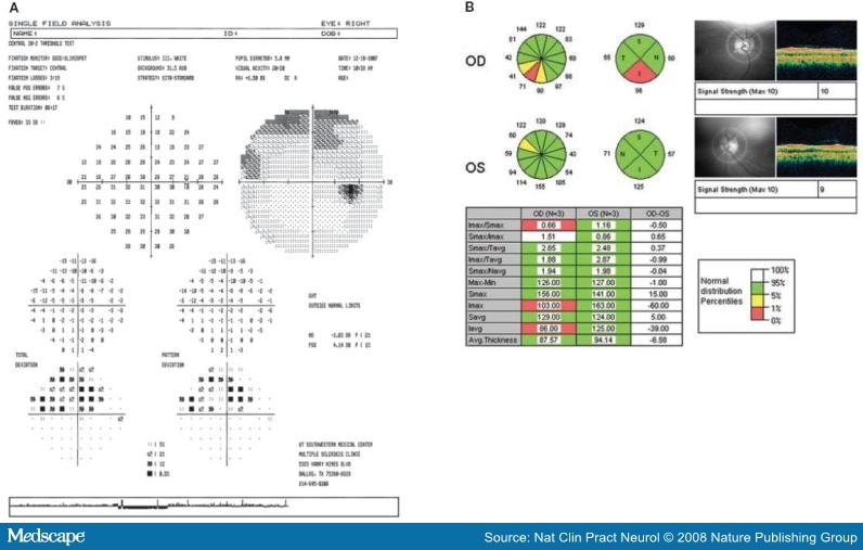 Visual Field Analysis