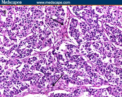 Hepatocellular Carcinoma Pathology