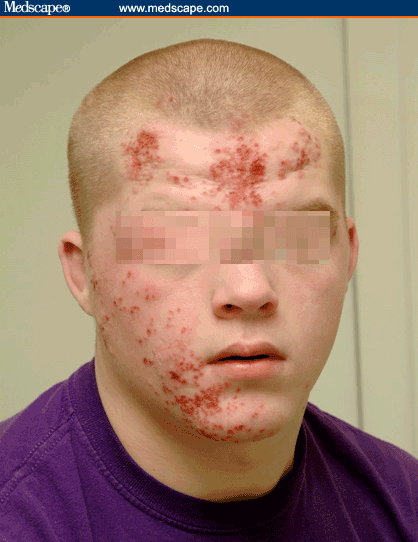 Herpes Rash