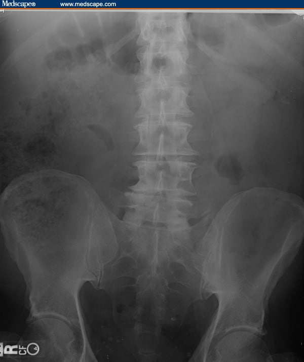 Left Lower Quadrant Abdominal Pain In A 60-year-old Man