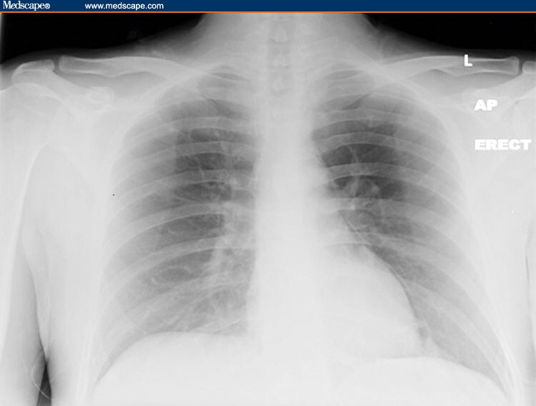 Interactive Thorax And Abdomen Crack Cocaine