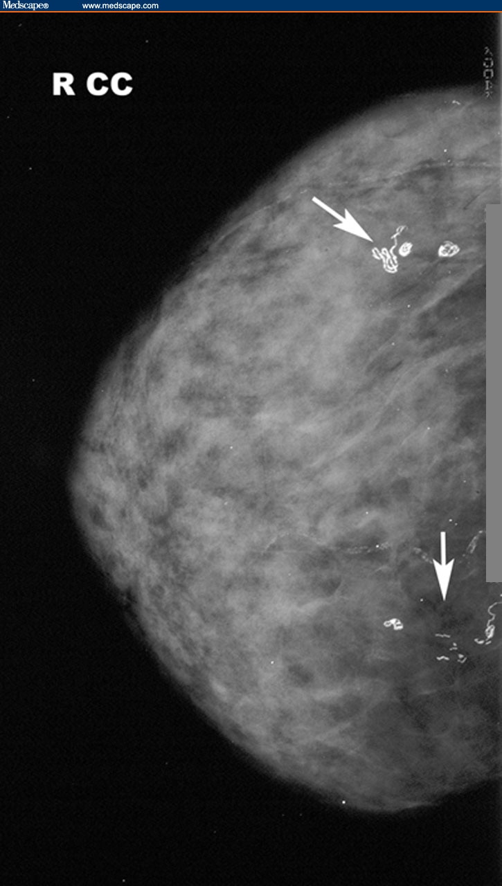Breast Calcifications 16