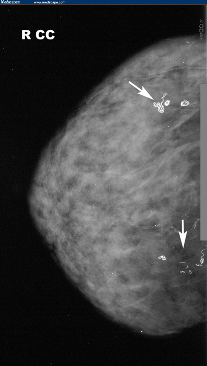 breast calcification clusters