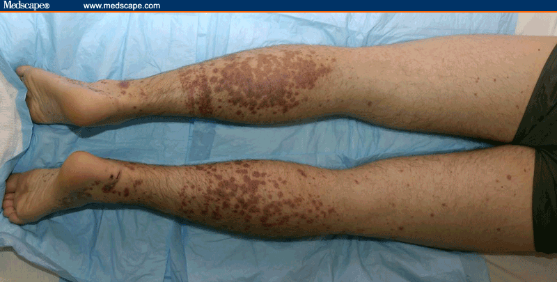 wind burn rash wind burn rash