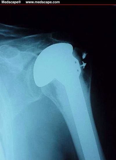 hemiarthroplasty knee