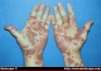 Bullous Erythema Multiforme