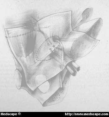 Myopectineal Orifice Anatomy