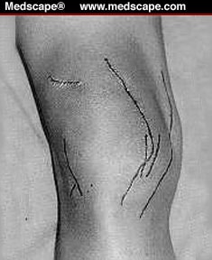 Knee Incisions