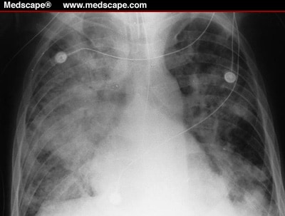 ACute resp Distress syndrome has increased dead space ventilation USMLE