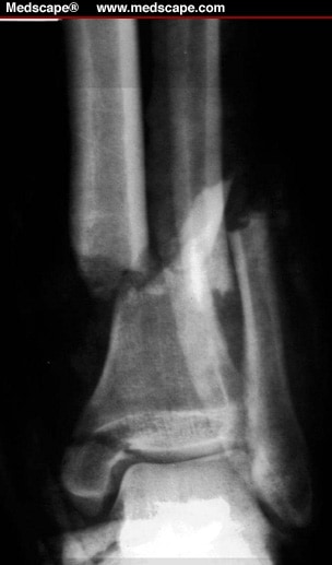 tibia and fibula fracture